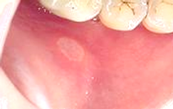 aphte buccal
