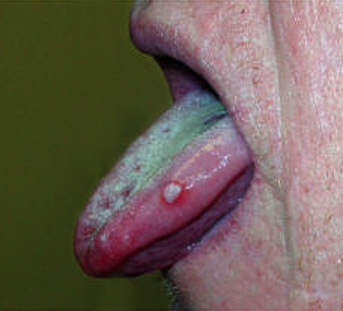 Ulcère viral aspect latéral