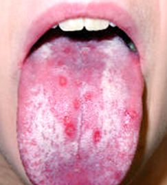 Herpès lingual primo infection