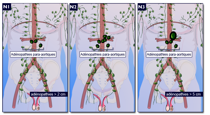 cancer testicules